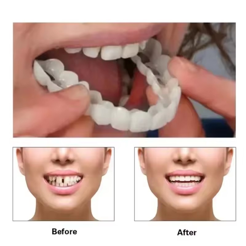 Teeth Veneers Whitening Dentur - Teeth Whitening Vape 리뷰 및 가격